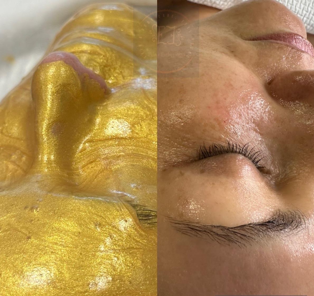 Tratamiento Facial