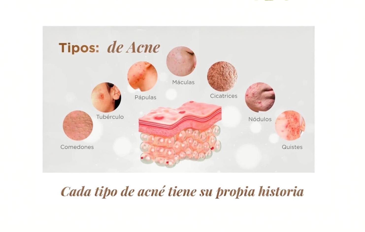 Tratamientos de acné